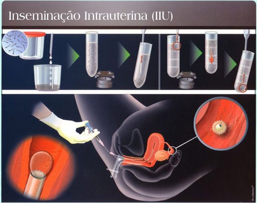 inseminação intra-uterina-3