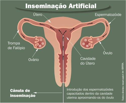 inseminação intra-uterina-4